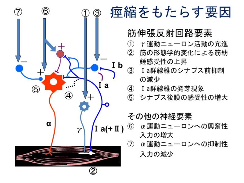 痙性をもたらす原因