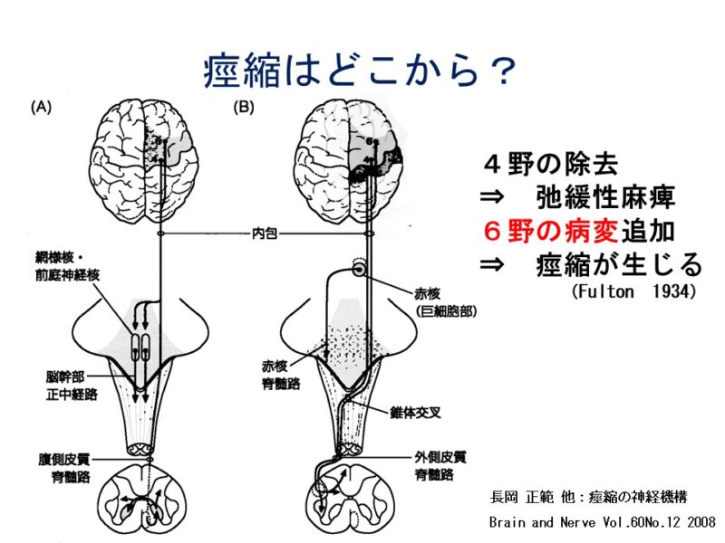 痙縮はどこから？