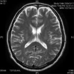 脳画像（MRI T2）